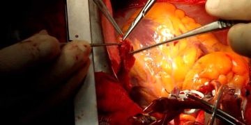 Ekstrakorporeal dolaşım ve myokardiyal koruma