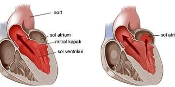 Mitral kapak hastalıkları tanı ve tedavisi
