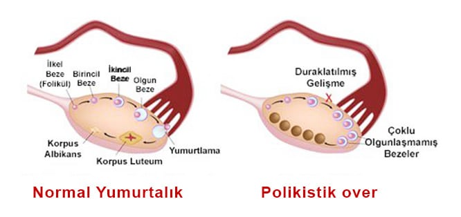 Polikistik over sendromu