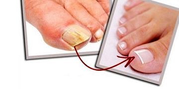 Tırnak mantarı nedir? Neden olur? Belirtileri ve tedavisi