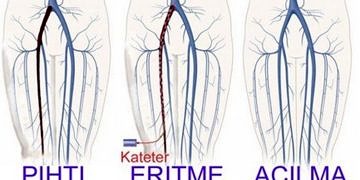 Bacaklardaki damar tıkanıkları tıraşlanarak ameliyatsız tedavi edilebiliyor