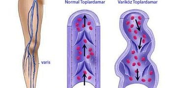 Kronik venöz yetmezlik (KVY) tanı ve tedavisi