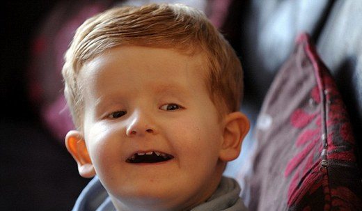 3 sarmallı dnası olan cocuk