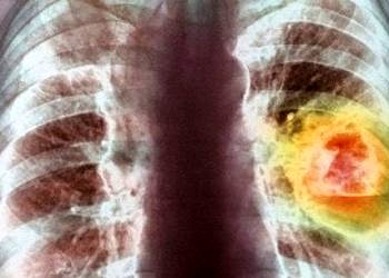 Egzersiz ve kanser ilişkisine yeni kanıt: Spor erkekleri kanserden koruyor
