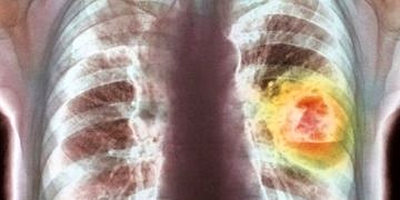 Egzersiz ve kanser ilişkisine yeni kanıt: Spor erkekleri kanserden koruyor