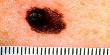 Kutanöz melanoma nedir, nedenleri ve tedavisi