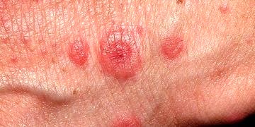 Eritema Multiforme nedir? Nedenleri, belirtileri ve tedavisi