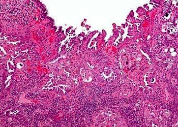 Skuamöz hücreli karsinom nedir? Belirtileri ve tedavisi