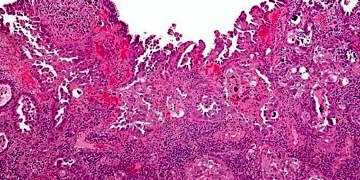 Skuamöz hücreli karsinom nedir? Belirtileri ve tedavisi