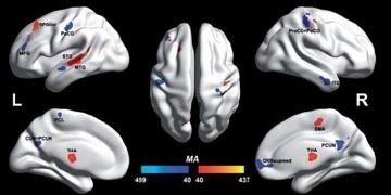 Otizmli ve otizmli olmayan bireylerin beyinleri ilk kez ayrıştırıldı