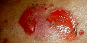 Pemfigus türleri, tanı ve tedavisi