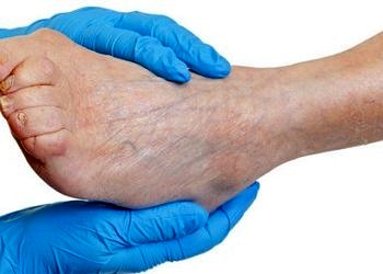 Periferik arter hastalıkları tanı ve tedavisi