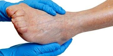 Periferik arter hastalıkları tanı ve tedavisi