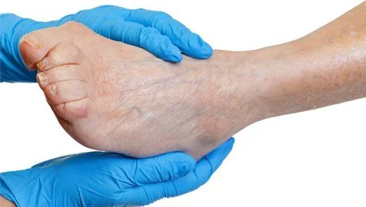 periferik-arter-hastaligi nedenleri tanısı tedavisi