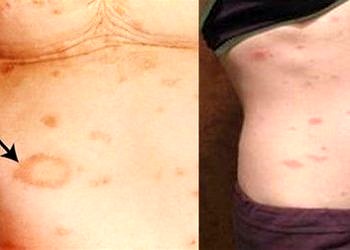 Pitriyazis Rozea (Gibert – Gül Hastalığı) nedir, tanı ve tedavisi