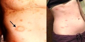 Pitriyazis Rozea (Gibert – Gül Hastalığı) nedir, tanı ve tedavisi