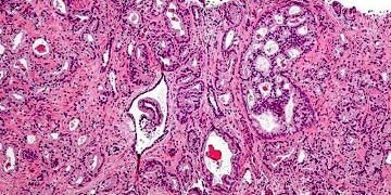 Omega-3 yağ asitlerinin prostat kanserini engellediği kanıtlandı