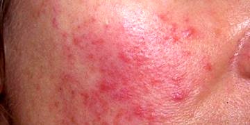 Rozase (gül) hastalığı tanı ve tedavisi