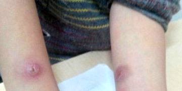 Kutanöz leishmaniasis (şark çıbanı) tanı ve tedavisi