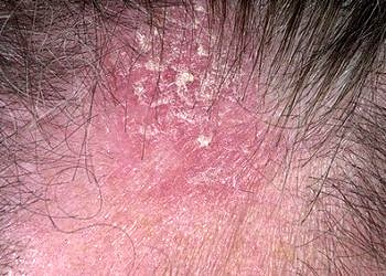 Seboreik Dermatit nedenleri ve tedavisi