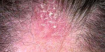 Seboreik Dermatit nedenleri ve tedavisi