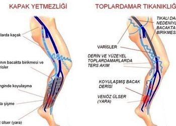 Yüzeysel venöz yetmezliğin cerrahisi tedavisi