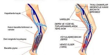 Yüzeysel venöz yetmezliğin cerrahisi tedavisi