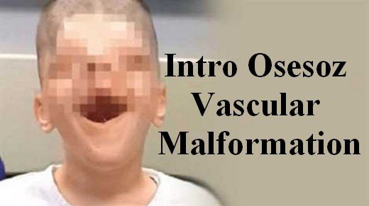 vmos kemik içi damar hastalığı