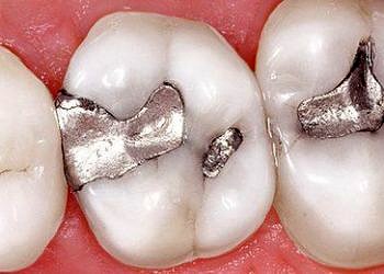 Amalgam (gümüş) dolgu zararlı mı? Cıva sağlık için ne kadar tehlikeli?