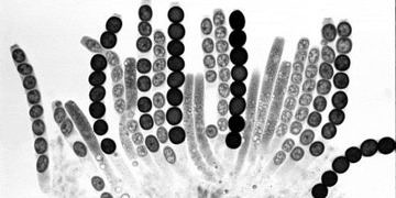 Smear testi sonucu ASCUS çıkan hastalarda tedavi