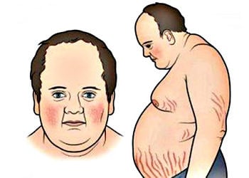 Cushing sendromu nedir? Nedenleri, belirtileri ve tedavisi