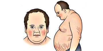 Cushing sendromu nedir? Nedenleri, belirtileri ve tedavisi