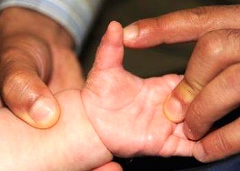 Doğumsal el anomalileri nedenleri ve tedavisi