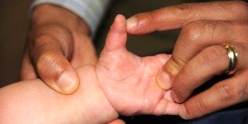 Doğumsal el anomalileri nedenleri ve tedavisi