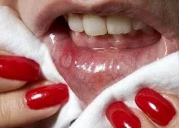 Dudak kanserlerinin nedenleri, belirtileri ve tedavisi