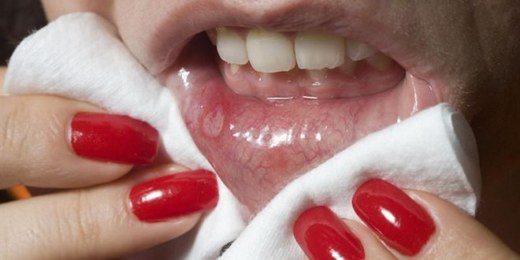 dudak-kanseri-nedenleri-belirtileri-tedavisi