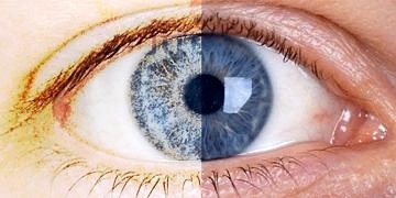 Göz kuruluğu neden olur? Ne iyi gelir? Belirtileri ve tedavisi