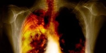 KOAH tehlikeli bir hastalık mıdır? Nedenleri nelerdir, tedavisi var mıdır?