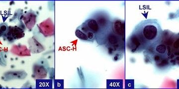 LSIL nedir, Smear sonucu LSIL çıkanlarda tedavi
