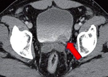 Mesane kanseri tanı ve tedavisi