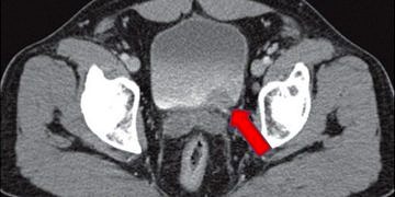 Mesane kanseri tanı ve tedavisi