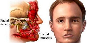 Bell paralizisi’ne yaklaşım
