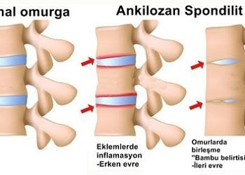Ankilozan spondilit (AS) nedir? Belirtileri, nedenleri ve tedavisi
