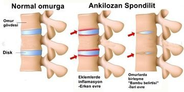 Ankilozan spondilit (AS) nedir? Belirtileri, nedenleri ve tedavisi