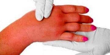 Arı ve böcek sokmasına ilk yardım nasıl olmalı? Arı sokmasına ne iyi gelir?