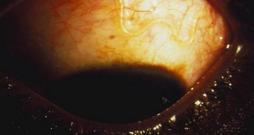 gözde parazit-solucan