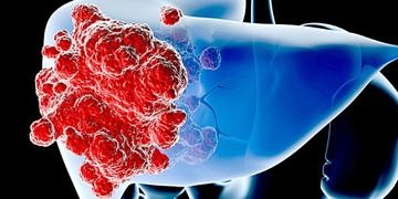 Karaciğer kanserinin ilerlemesine neden olan klit bir unsur keşfedildi