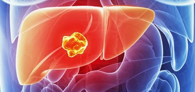 Karaciger Kanseri Neden Olur Belirtileri Nedenleri Ve Tedavisi