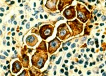 Ret proteini aktivasyonu ile meme kanseri tedavisinde yeni bir yaklaşım