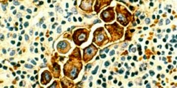 Ret proteini aktivasyonu ile meme kanseri tedavisinde yeni bir yaklaşım